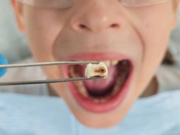 Best Knocked-Out Tooth Emergency  in Punta Gorda, FL